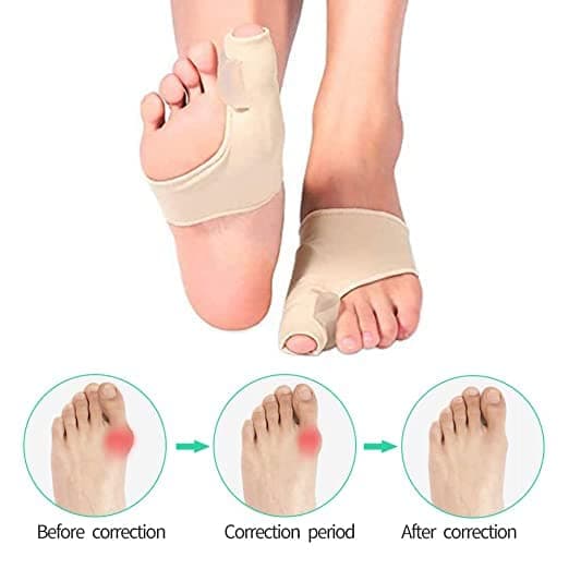 KARELLS separator deget correție hallux valgus, șosete bandaj, separator degete, correție hallux valgus zi/noapte, 4buc